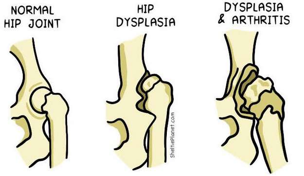 Hip Dysplasia Illustration Hip Dysplasia Illustration