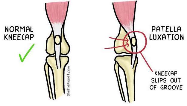 Patella Luxation Illustration Patella Luxation Illustration