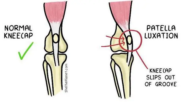 Patella Luxation Illustration Patella Luxation Illustration